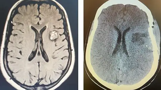 BAÜN Hastanesi'nde riskli beyin ameliyatı başarıyla yapıldı